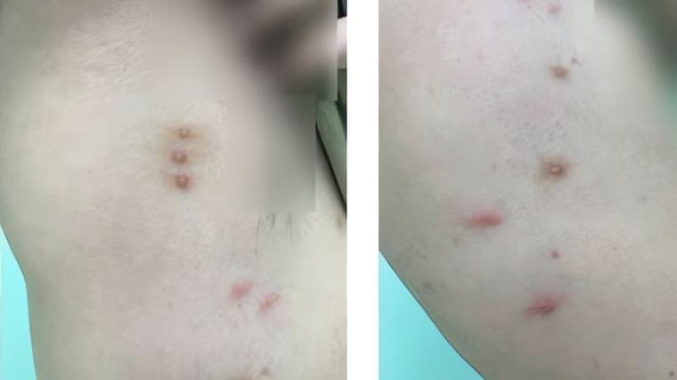 Sẩn đỏ trên da với dấu hiệu "ngày 3 bữa", thủ phạm khó lường đang "ngủ chung" với bệnh nhân